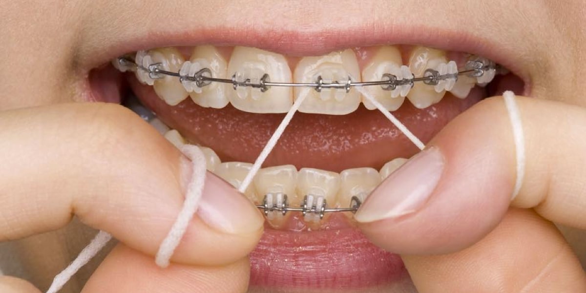 Conventional Braces